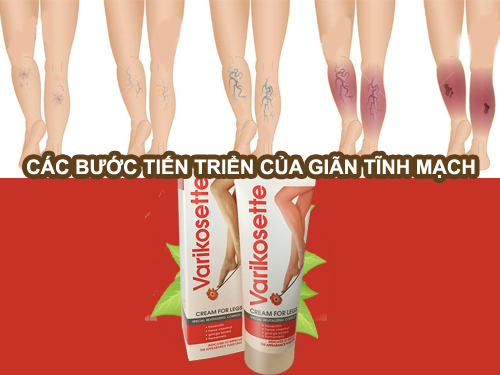suy giãn tĩnh mạch