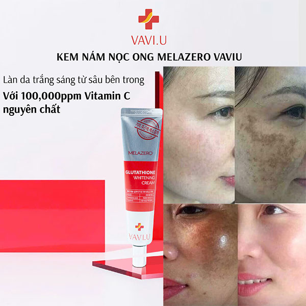 trị nám lâu năm